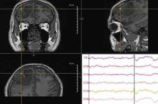Beyin Kanamas Sonras Epilepsi