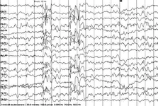 Miyoklonik Epilepsi Belirtileri ve Tedavisi