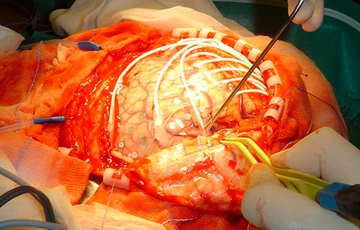 Epilepsi Ameliyatı Nasıl Yapılır?