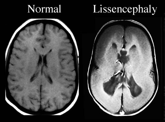 Epilepsi Belirtileri