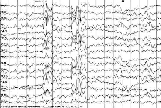 Miyoklonik Epilepsi